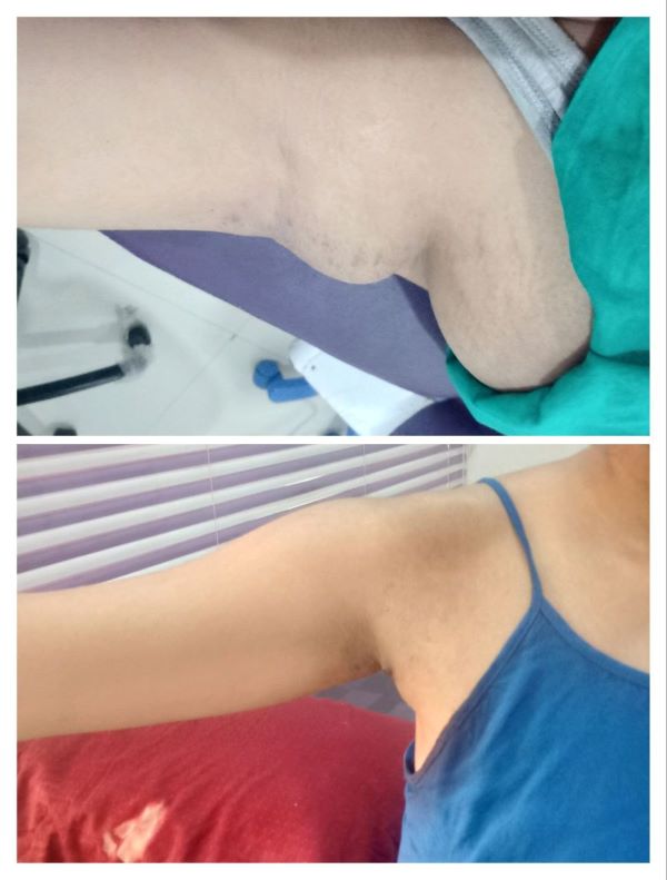 Bra Bulge Removal Before After